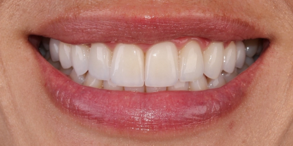 Depois do tratamento — Lentes de Porcelana