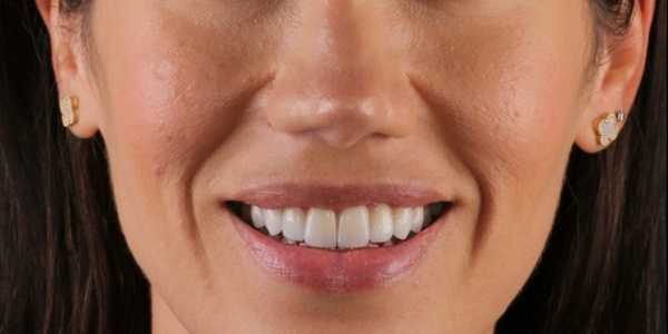 Depois do tratamento — Lentes de Porcelana