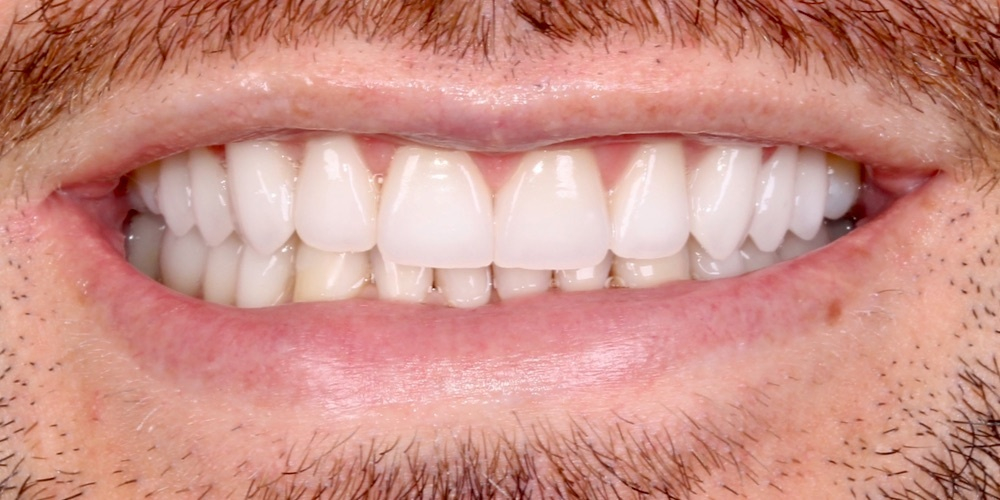Depois do tratamento — Lentes de Porcelana