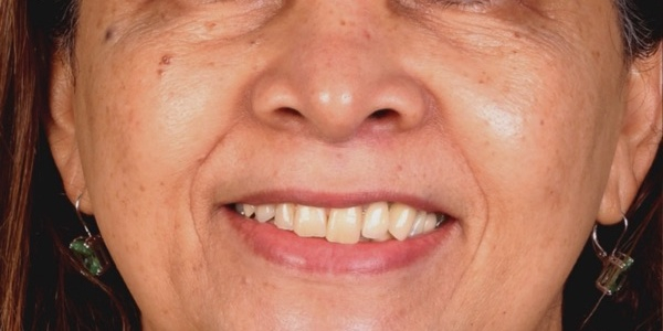 Antes do tratamento — Reabilitação Oral
