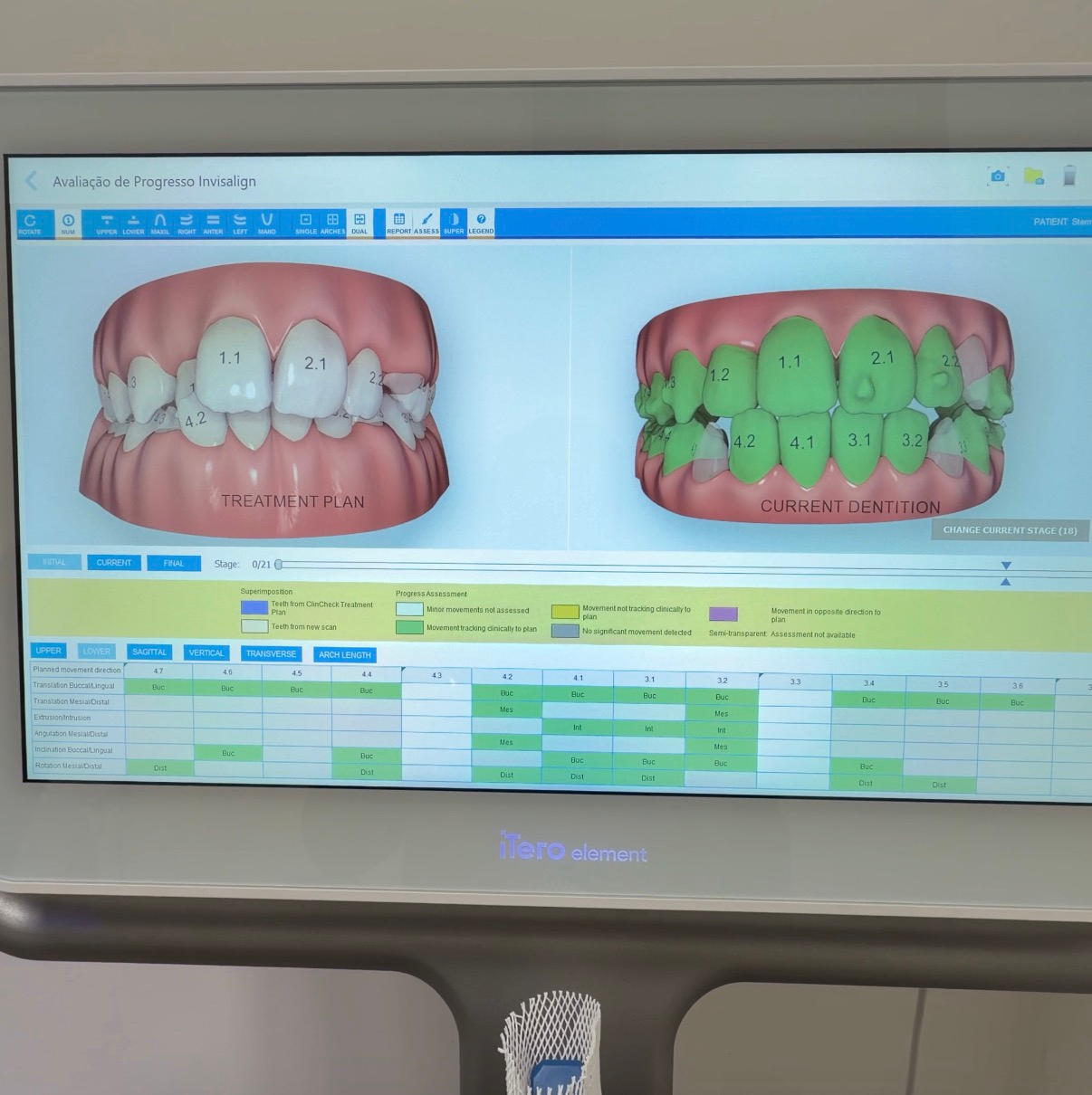 Tela do iTero mostrando o planejamento digital do movimento dos dentes