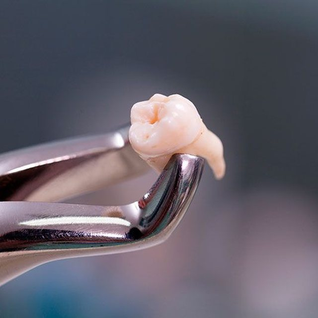 Cirurgia de Siso