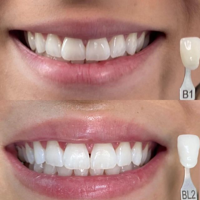 Clareamento Dental
