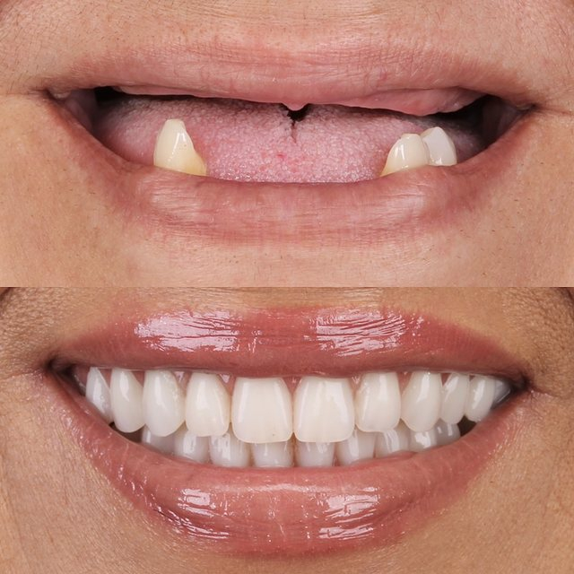 Implantes Dentários