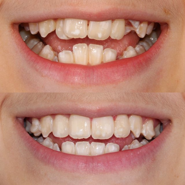 Invisalign